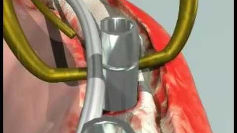 Intra Oral Welding Device