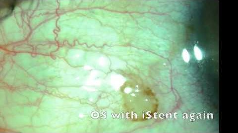 iStent Function: slit lamp demonstration by Steven G. Safran MD