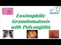 Eosinophilic Granulomatosis with Polyangiitis (EGPA) | Churg-Strauss Syndrome, Autoimmune Vasculitis