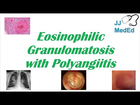 Eosinophilic Granulomatosis with Polyangiitis (EGPA) | Churg-Strauss Syndrome, Autoimmune Vasculitis