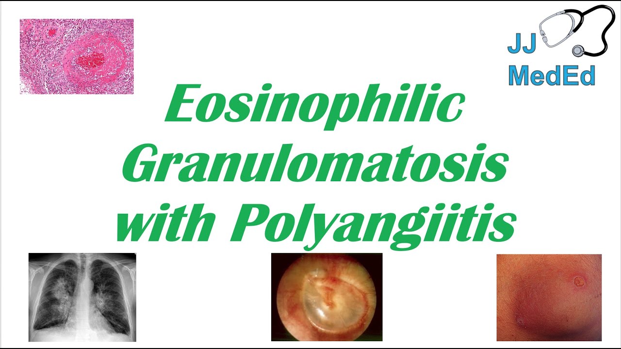 Eosinophilic Granulomatosis With Polyangiitis Egpa Churg Strauss
