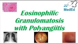 Eosinophilic Granulomatosis with Polyangiitis (EGPA) | Churg-Strauss Syndrome, Autoimmune Vasculitis