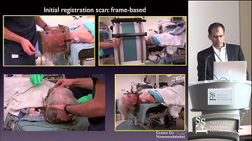 Awake vs Asleep DBS for Movement Disorders by Francisco Ponce, MD