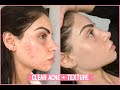 Textured Acne Clarifying Facial on @Nazanin Kavari | Jadeywadey180