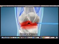 Do Gel Injections For Knee Arthritis Work?