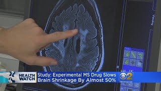 Celebrity New Drug Shows Promise For Patients With Progressive Multiple Sclerosis Profile
