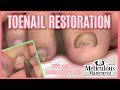 👣How to Pedicure for Beginners on Impacted Deformed Toenails👣