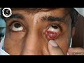 Gigantic conjunctival cyst pushing globe upwards