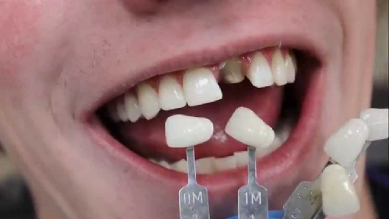 Crowns R Us Dental Lab YouTube