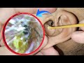 Deep Dry Earwax Removal From Infected Ear Canal | ASMR Horror 😵 | EP 128
