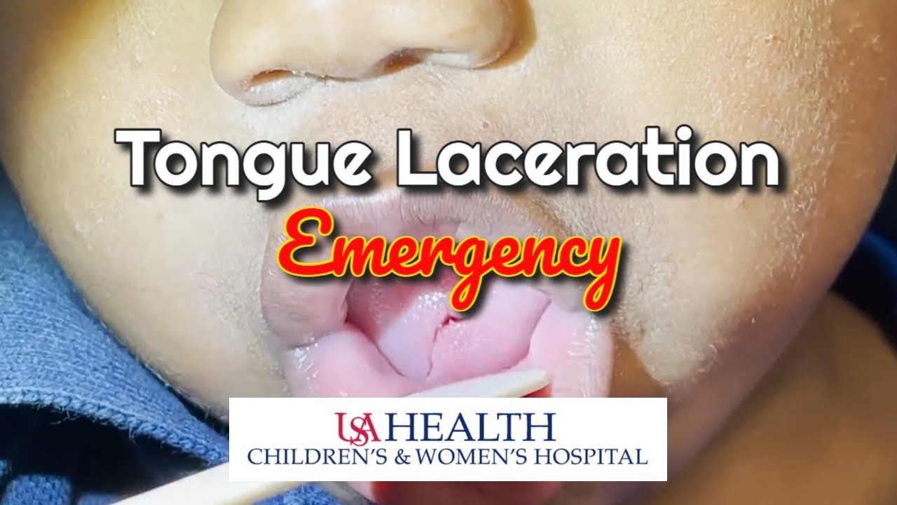 Pediatric Tongue Laceration Emergency - YouTube