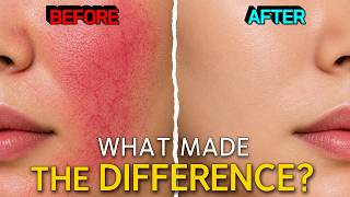 Facial Redness & Broken Capillaries: Laser Treatments and Before & After Real Cases
