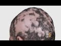 Dr max gomez alopecia treatment