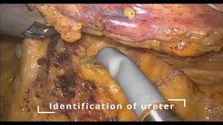 Robotic Sigmoid Colectomy using Hugo™ RAS system