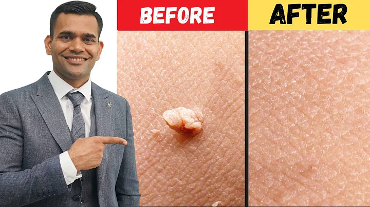 Say Goodbye to Skin Tags and Warts in Just 24 Hours!