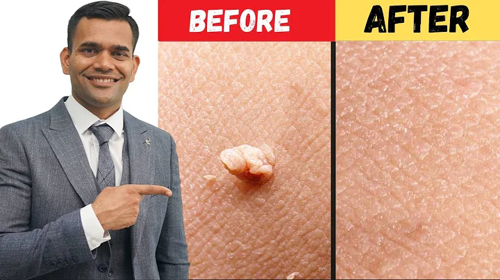 Ta bort hudtaggar och vårtor inom 24 timmar - Dr. Vivek Joshi