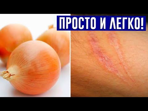 Вопрос: Как избавиться от шрама из за стригущего лишая?