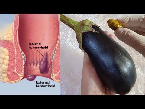 Treatment of internal and external hemorrhoids and anal fissures without surgery