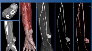 Dual-Energy CT Angiography and 3-D Imaging of Vascular Lesions of the Hand and Forearm screenshot 4