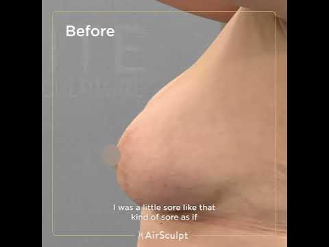 Testimonial: Viktoria Up-A-Cup Fat Transfer Procedure 