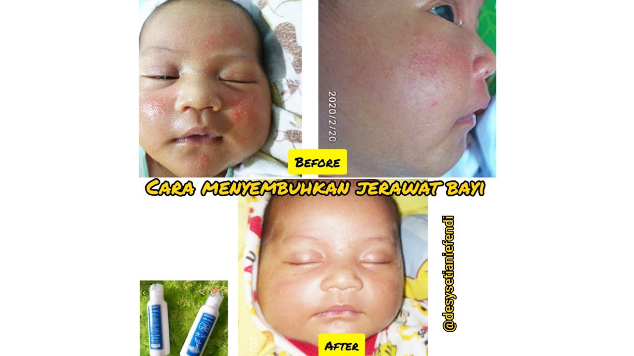 Cara menyembuhkan jerawat bayi 