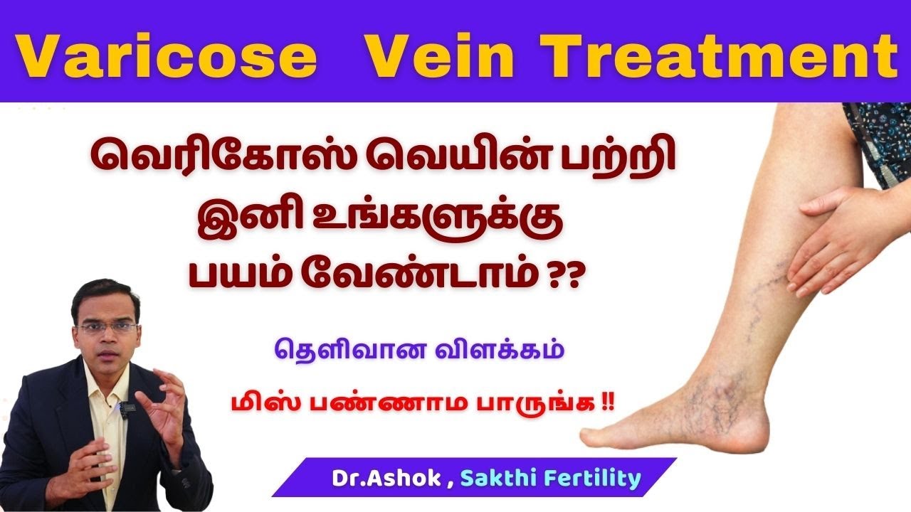 வெரிகோஸ் வெயின் பற்றி இனி உங்களுக்கு பயம் வேண்டாம்!! Varicose Vein Treatment