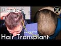 5 months after 2nd fuedhi hair transplant 6500 grafts norwood 5