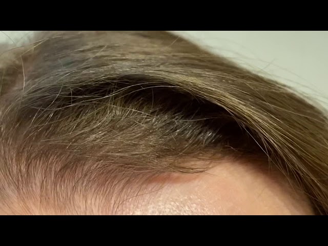 Dallas Female Hairline Lowering 5 Months After Close-Up