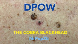 DPOW- The Cobra Blackhead. Back blackhead extractions with ingrown hairs. Follicular cyst pops.