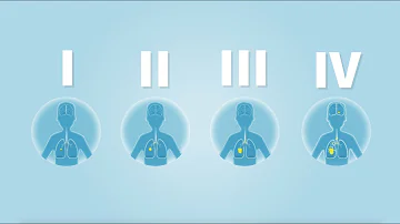 Wie schnell schreitet Lungenkrebs voran?