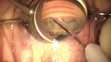 Glaukos iStent with Narration