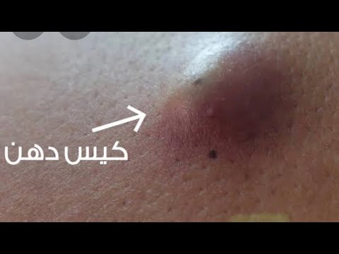 طريقه مجربه وفعاااله لعلاج الكيس الدهني تحت الجلد في أي مكان في الجسم بدون لجوء للجرااحه تخلص تام
