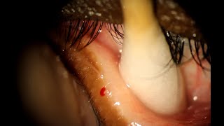 Explosion at 1:39 Popping Eyelid Cyst with Maskin Needle