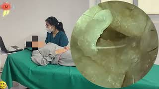 采耳哥 | Giant Earwax Blockage | Disturbing but Satisfying Removal #GN432