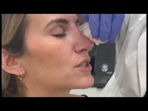 Video thumbnail: Non-Surgical Rhino- Tip Correction · The Spiegel Center
