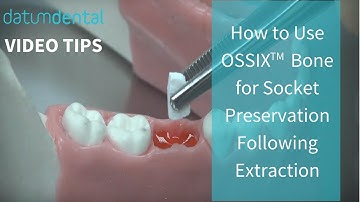 Video Tips: How to Use OSSIX Bone for Socket Preservation Following Extraction