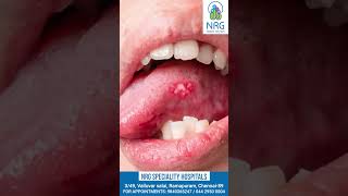 Home treatment for mouth ulcers