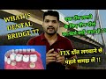 Fixed दाँत कैसे लगाये जाते है ? Dental bridge ?? Tooth supported fixed Bridge ??