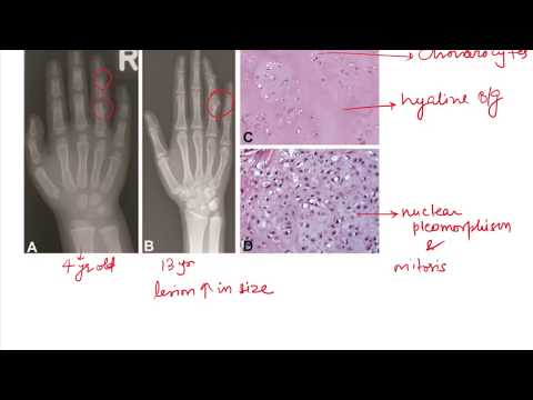 Ollier Disease and Maffucci Syndrome