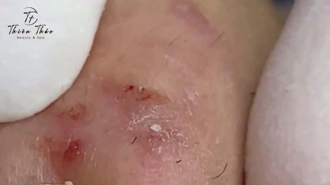 Popping huge Blackheads & Milia, Big cystic acne blackheads extraction whiteheads #068 #415
