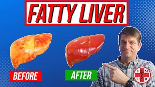 Don't Let Fatty Liver Become Liver Failure | 6-Step Prevention Plan