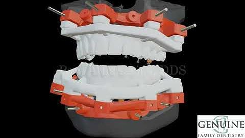 All on Four Dental Implants Digital Workflow