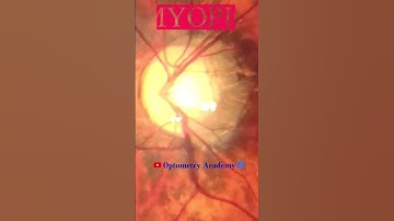 Myopic Fundus | Fundus Photography | Myopic Crescent | Short Video 160 #viral #optometryacademy