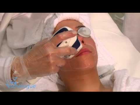 Epilazione laser del viso nel giubbotto Epilazione laser del viso nel giubbotto