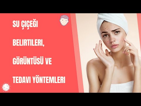 Su Çiçeği Belirtileri, Görüntüsü ve Tedavi Yöntemleri | Doktorify