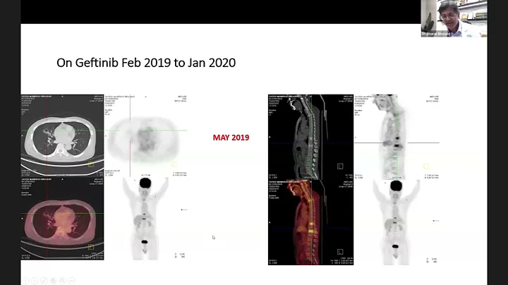 NGS & Liquid Biopsy in Lung Cancer: Moving Beyond Driver Mutations