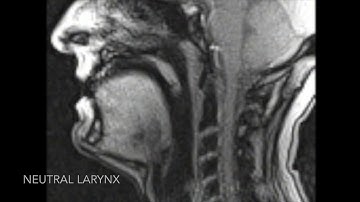 MRI Laryngeal Movement