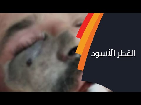 ما هو مرض الفطر الأسود