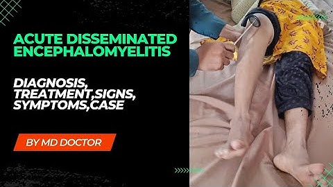 ADEM | APPROACH TO ACUTE DISSEMINATED ENCEPHALOMYELITIS | DIAGNOSIS, TREATMENT | DEMYELINATION |