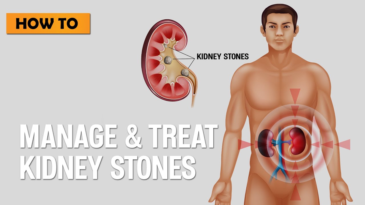 How to manage and treat Kidney Stones - YouTube